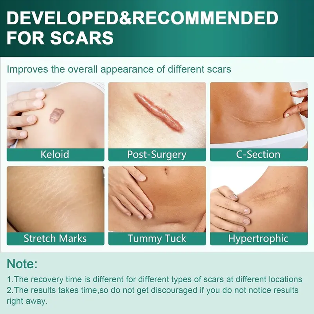 Alisanda Silicone Scar Roll – Heals Scars, Keloids & C-Section Marks Fast