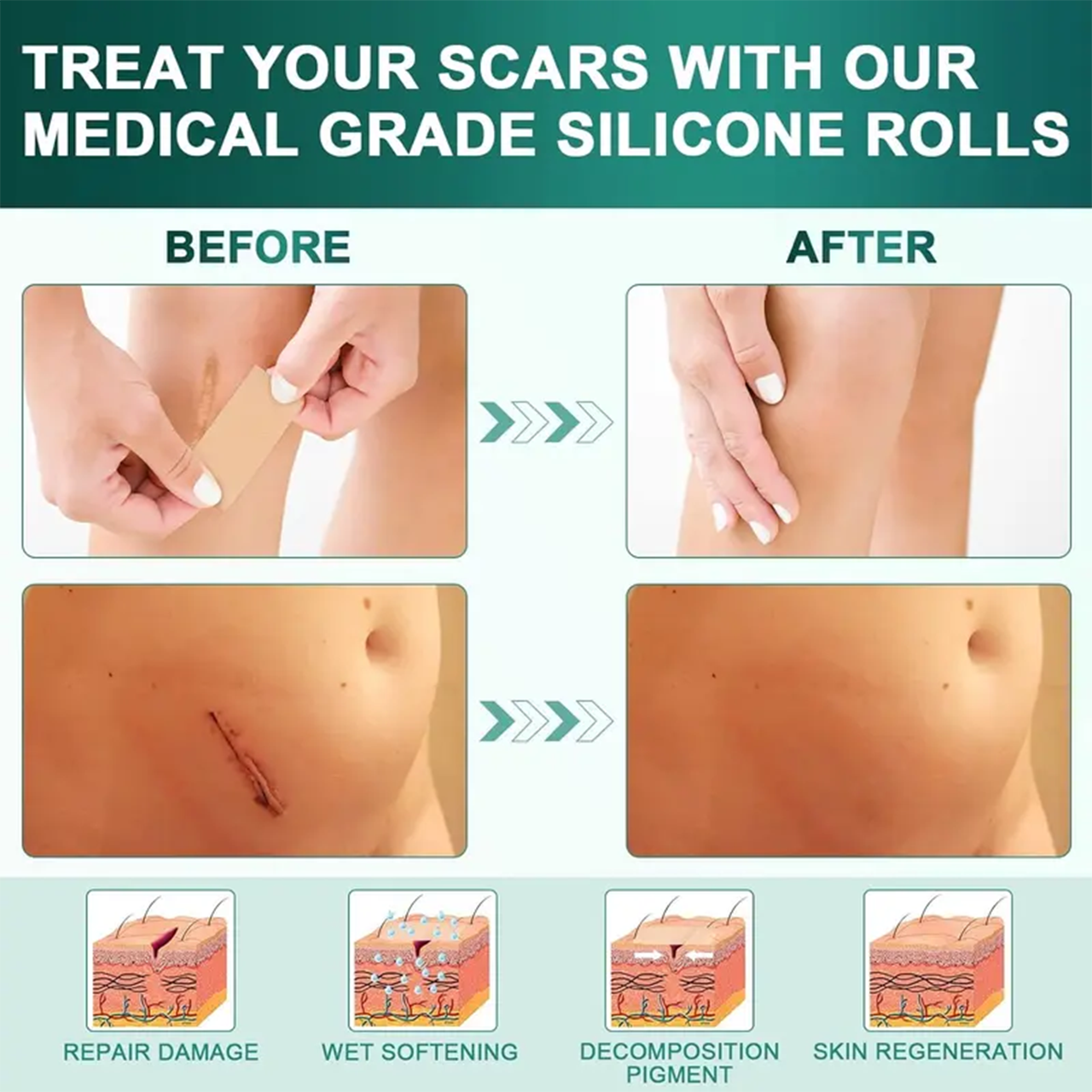 Alisanda Silicone Scar Roll – Heals Scars, Keloids & C-Section Marks Fast