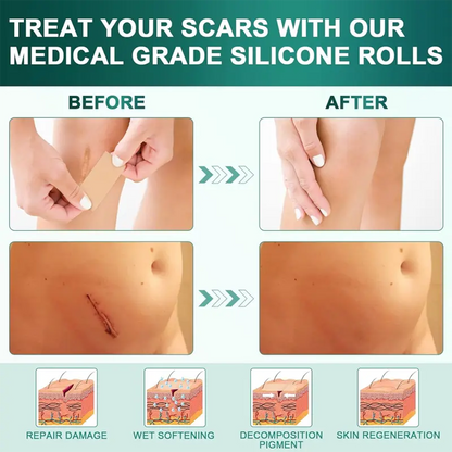 Alisanda Silicone Scar Roll – Heals Scars, Keloids & C-Section Marks Fast